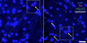 Protein Linked to Sex Differences in Age-Related Neuron Loss